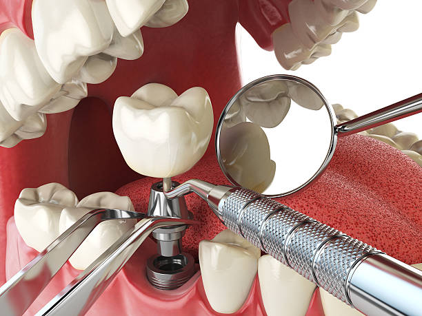 Best Knocked-Out Tooth (Avulsed Tooth) Treatment in Pinole, CA